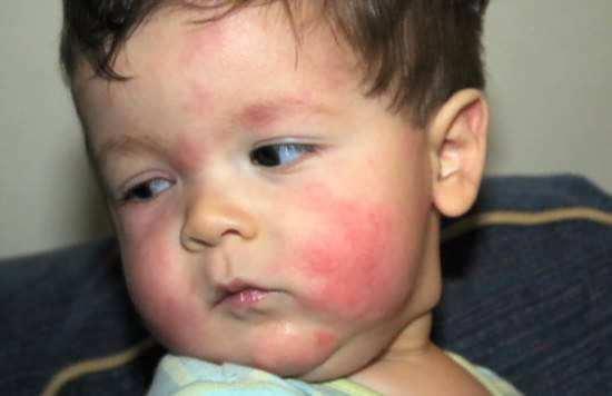 小孩吃毛瓜过敏,警惕常见食物引发的健康危机