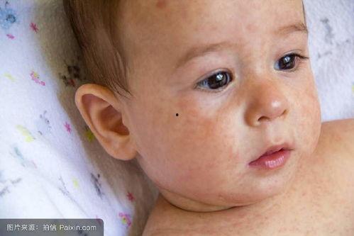 小孩吃毛瓜过敏,警惕常见食物引发的健康危机